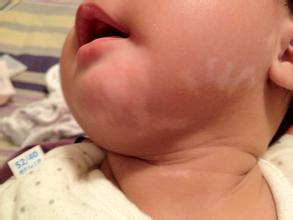 婴儿脸上有小白点的原因有哪些