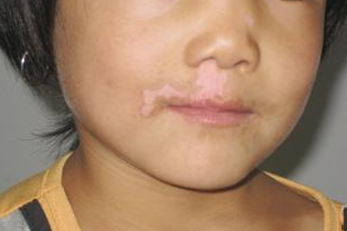 儿童嘴唇白癜风治疗的方法有哪些呢